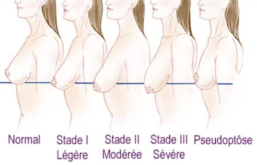 Schéma présentant es différents stades de ptose mammaire